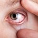 Sabia que a Artrite Reumatoide pode afetar os olhos?