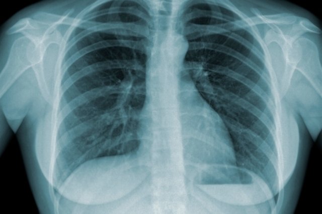 Tuberculose: 6 sintomas que podem indicar a infecção