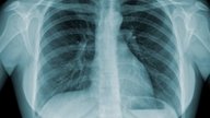 6 principais sintomas de tuberculose