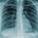 6 principais sintomas de tuberculose