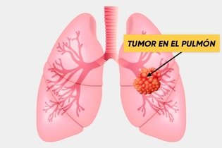 Imagen ilustrativa del artículo Cáncer de pulmón: 10 síntomas principales y diagnóstico