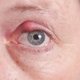 Bolinha no olho: 6 principais causas (e o que fazer)