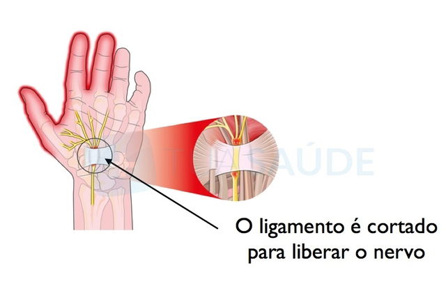 Cirurgia Para Túnel Do Carpo Como é Feita E Recuperação Tua Saúde