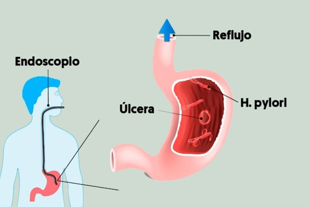 Endoscopia: cos'è, a cosa serve e come prepararsi 