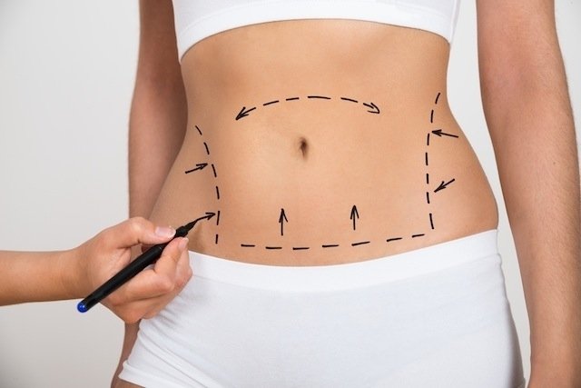 شفط الدهون بالليزر: ما هو وكيف يعمل وما بعد الجراحة