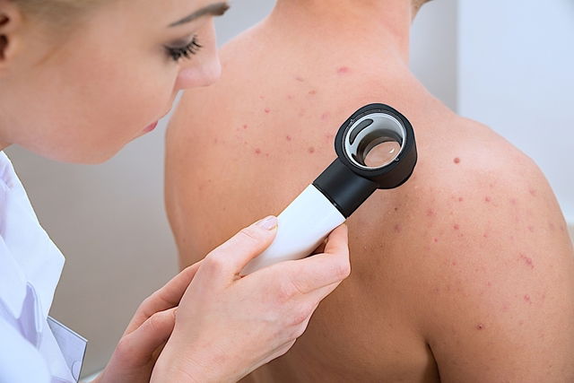 Tinea Versicolor: Causes, Symptoms, & Treatment