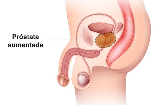 Adenomul de prostată: cauze, simptome, tratament