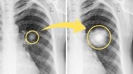 Nódulo pulmonar: qué es, síntomas y cuándo es cáncer