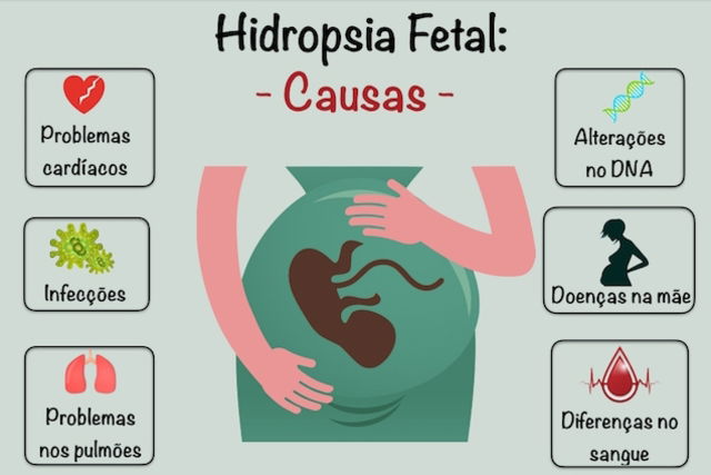 Hidropsia Fetal Causas E Diagn Stico E Complica Es Tua Sa De The Best Porn Website