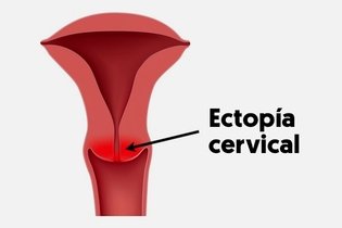 Imagen ilustrativa del artículo Tratamiento para curar el ectropión/ectopia cervical 