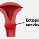Tratamiento para curar el ectropión/ectopia cervical 