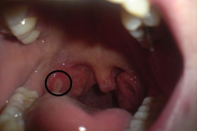 sinus-drainage-and-canker-sores-best-drain-photos-primagem-org