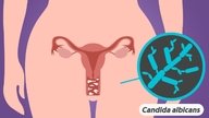 Candidíase vaginal: o que é, sintomas e opções de tratamento