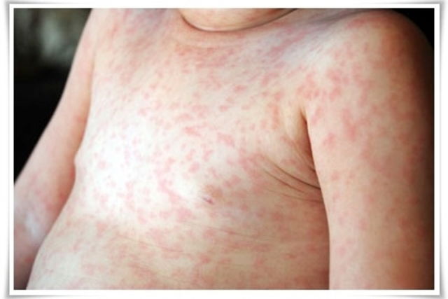 Roseola (Sixth Disease) Symptoms & Causes