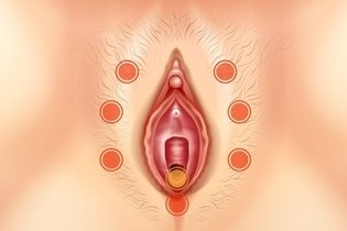 Illustrative image of the article Vulvodynia: What Is It, Symptoms, Causes & Treatment