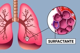 Imagen ilustrativa del artículo Surfactante pulmonar: qué es y cuál es la función