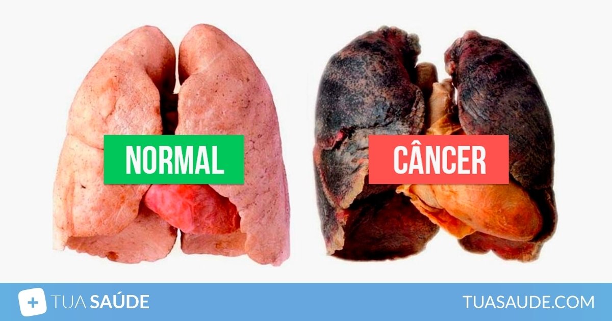 7 opções de tratamento do câncer de pulmão - Tua Saúde