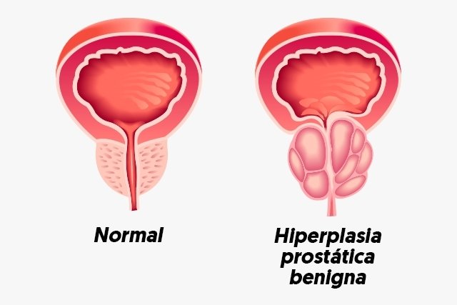 hipertrofia prostática benigna