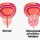 Hiperplasia benigna da próstata: o que é, sintomas, causas e tratamento