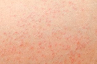Illustrative image of the article Petechiae: Causes, Symptoms, Treatment & When to Worry