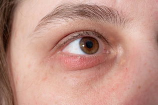 Imagen ilustrativa del artículo Bolita en el ojo: 6 causas y qué hacer