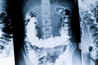 Trombose intestinal: o que é, sintomas, causas e tratamento