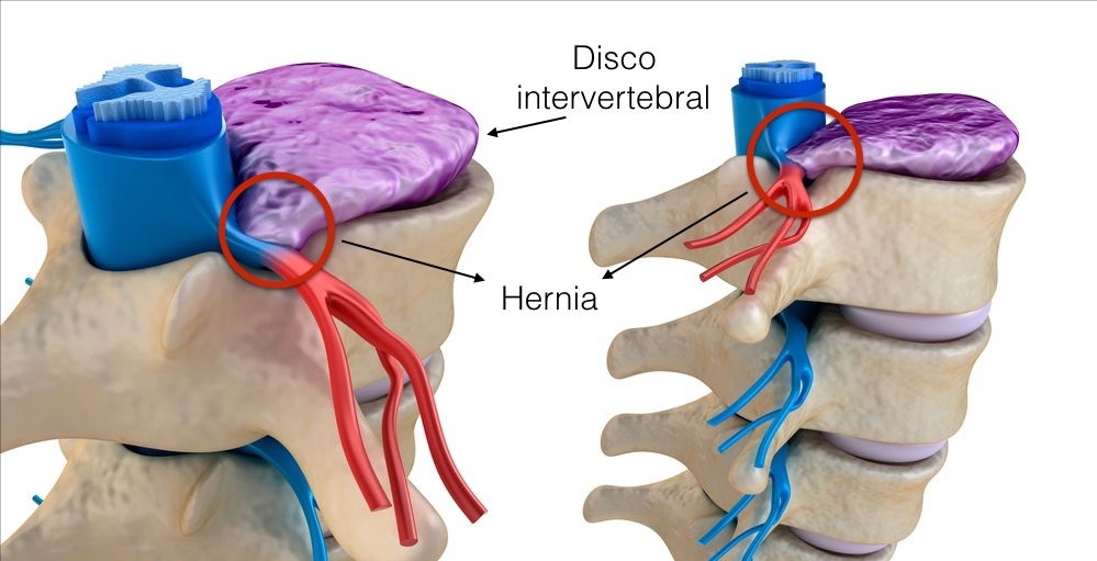 Síntomas De Hernia Discal Lumbar Cervical Y Torácica Tua Saúde 2088