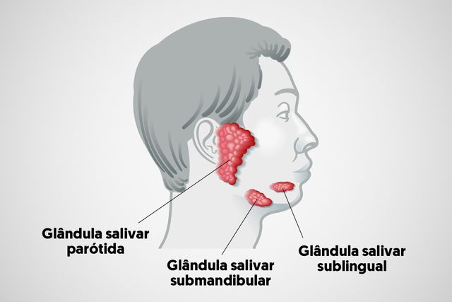 Sintomas que podem indicar um câncer de glândulas salivares