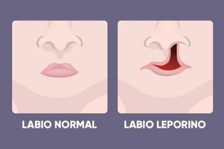 Imagen ilustrativa del artículo Lábio leporino: qué es, causas y tratamiento
