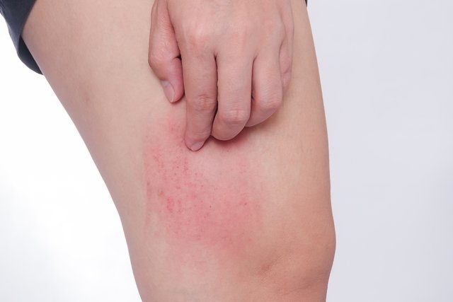 Taches rouges sur les jambes: 7 causes (et que faire) - Tua Saúde
