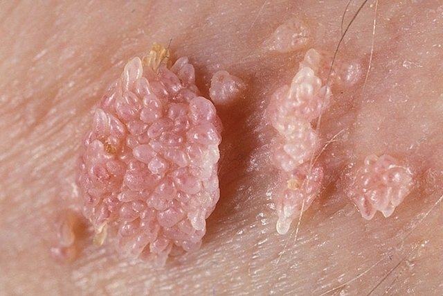 virus del papiloma labios genitales