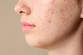 Imagen ilustrativa del artículo 12 causas de acné (y cómo tratar)