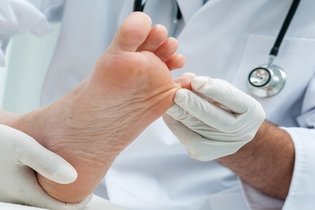 Micose no pé (frieira): o que é, sintomas e tratamento