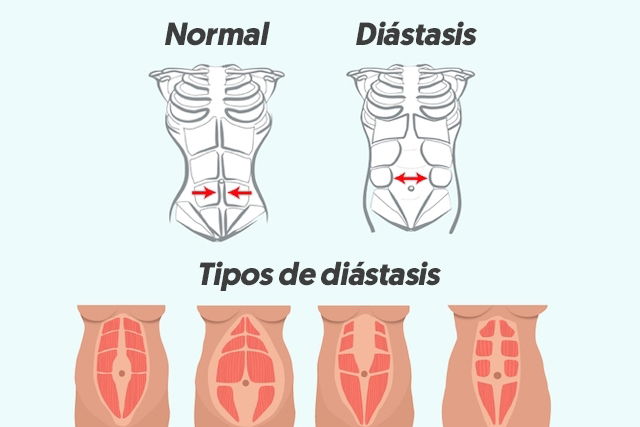 Por qué no se marcan los abdominales? Acá los motivos y cómo