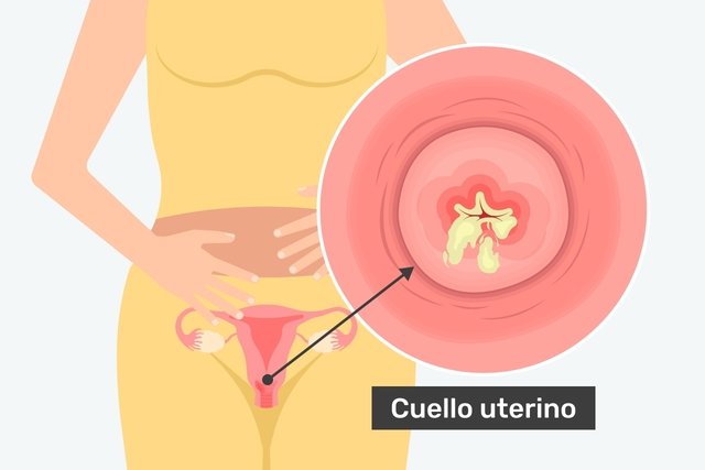 Cuello uterino con cervicitis