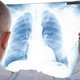 Fibrose pulmonar: o que é, sintomas, causas e tratamento
