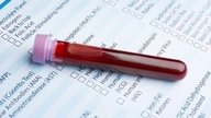 TSH Blood Test: What It's For & Why It's High or Low