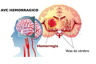 Como Fica O C Rebro Depois Do Avc Hemorr Gico