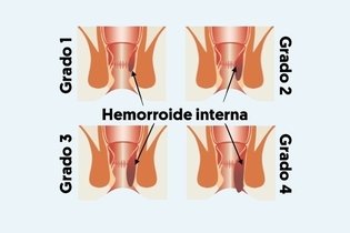 Imagen ilustrativa del artículo Cirugía para las hemorroides: 6 principales técnicas y cuidados 