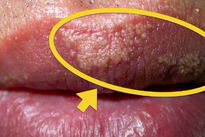 White pimples on penis