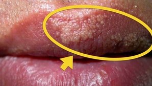 Papules vs herpes penile Evaluation of
