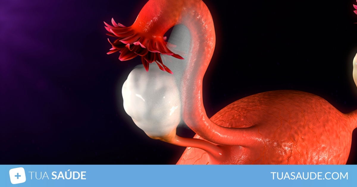 Endometriose: o que \u00e9, sintomas, causas e d\u00favidas comuns - Tua Sa\u00fade