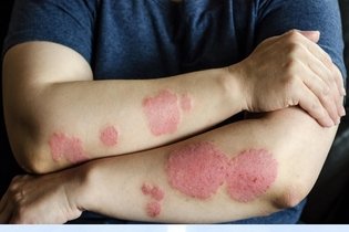 Imagem ilustrativa do artigo Eczema numular: o que é, sintomas, causas e tratamento