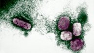 Varíola dos macacos (Monkeypox): o que é, sintomas, tratamento e cura