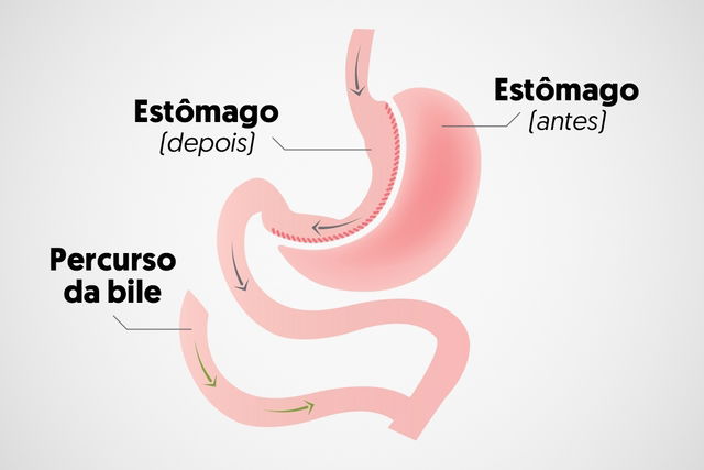 Entenda o que é e como é feita cirurgia bariátrica, procedimento