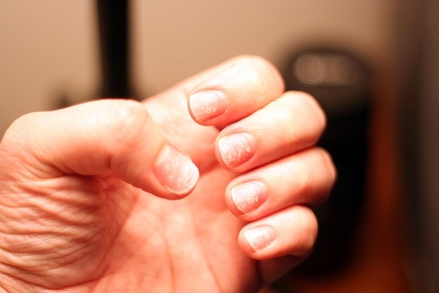 What Causes Glossy Fingernails? | Dry nails, Brittle nails, Nails