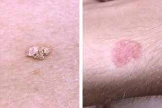 Como é feito o tratamento para câncer de pele