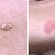 Como é feito o tratamento para câncer de pele