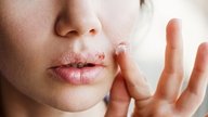 Herpes labial: o que é, sintomas, causas e tratamento