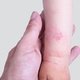 Dermatitis atópica: qué es, síntomas y tratamiento